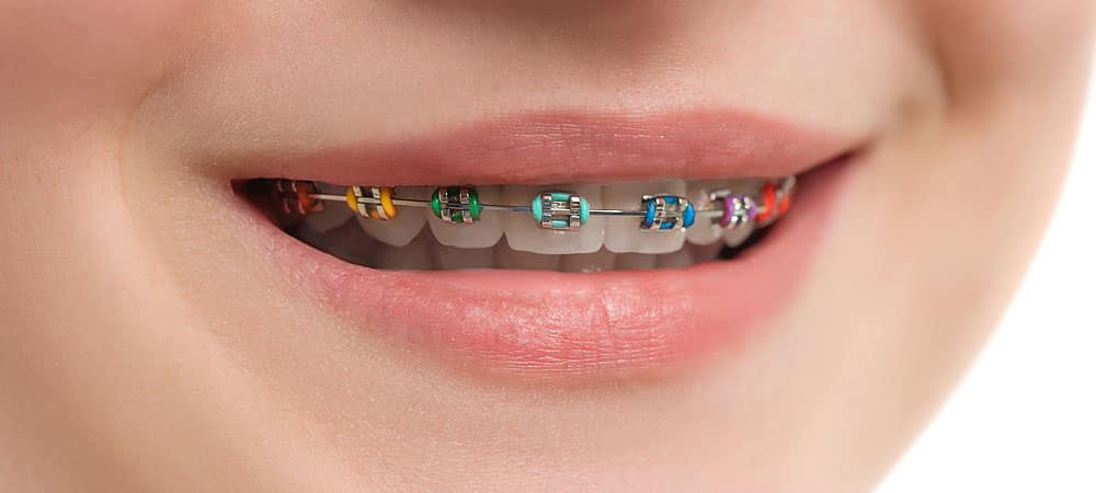 Bunte Brackets für Kinder