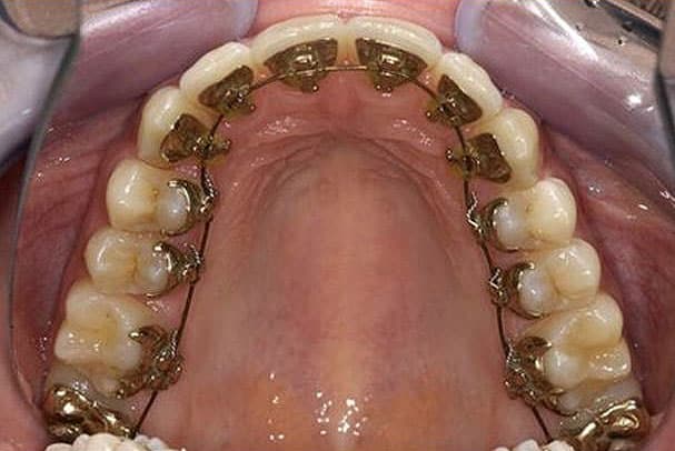 Linguale Orthodontie (Incognito)