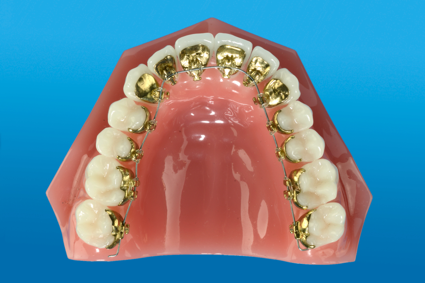 Linguale Orthodontie (Incognito)